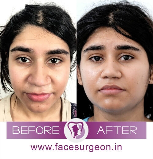 http://Nose%20Size%20Reduction%20Surgery%20India