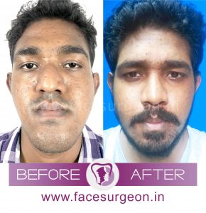 Maxillofacial Jaw Surgery in India