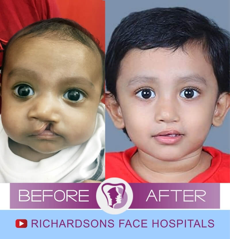 Agasthya Cleft Lip Palate Surgery