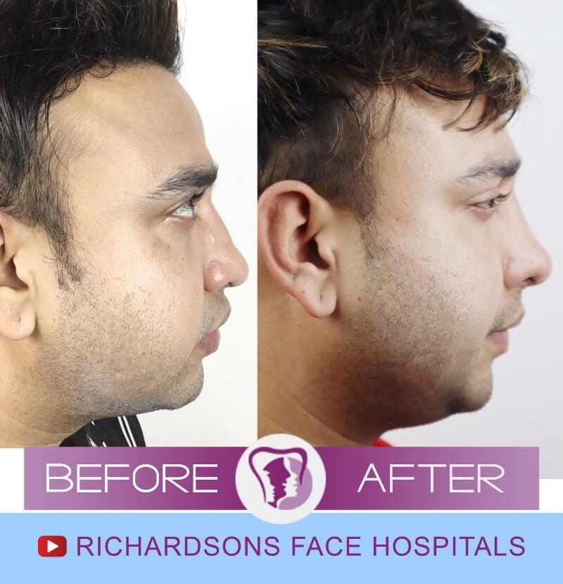 Akshit Nose Surgery Side View