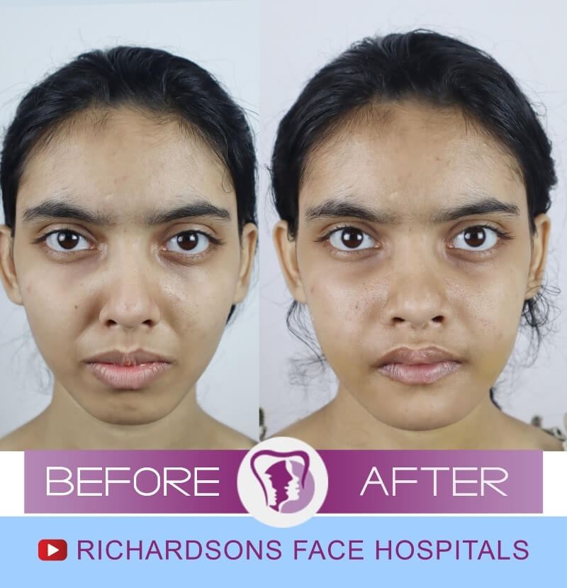 Amruta Jaw Surgery in India