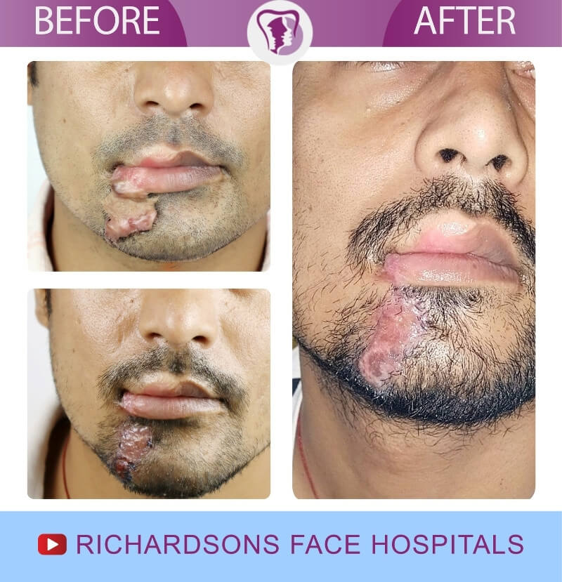 http://Anil%20Scar%20Removal%20Surgery