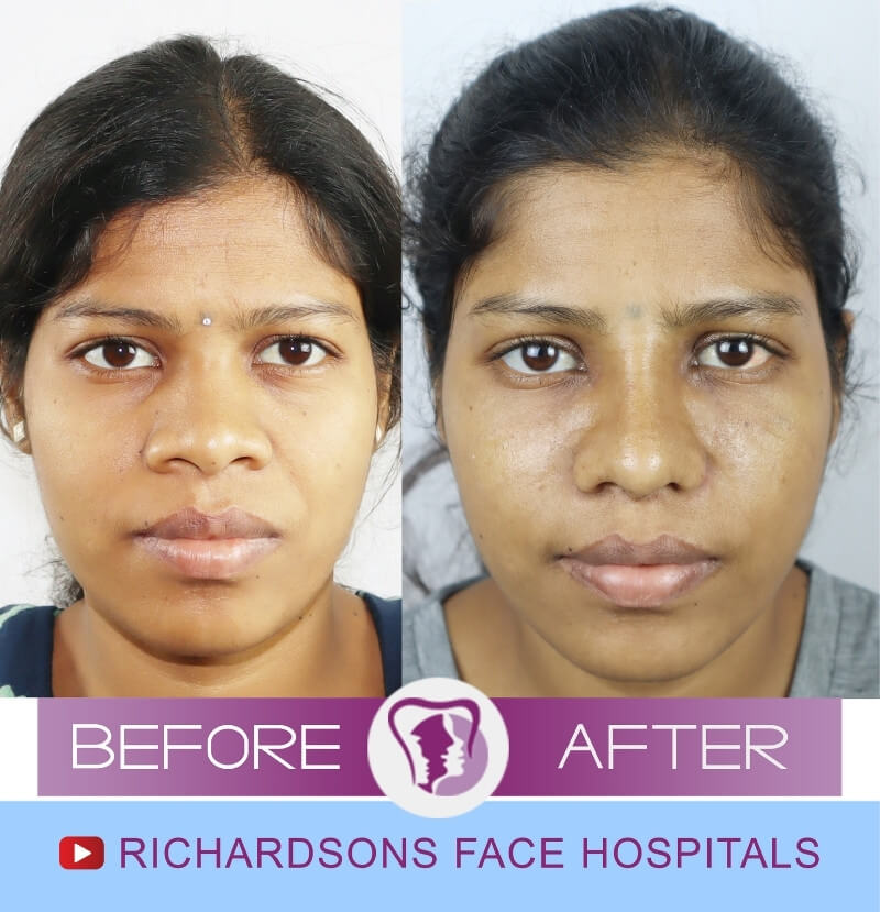 Aruna Rhinoplasty Surgery