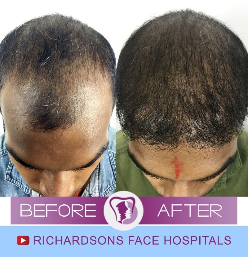 Hair Transplant - Richardson's Plastic Surgery Hospitals