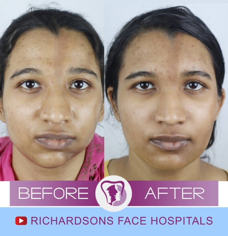 Asma Jaw Surgery in India