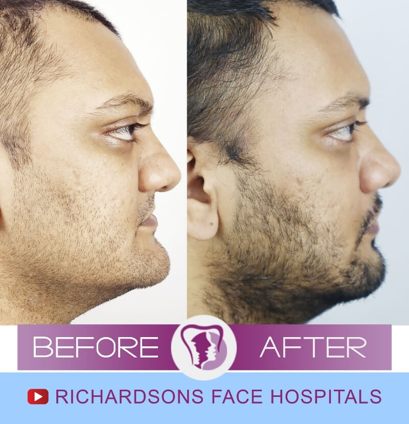 Bharathwaj Nose Surgery Side View