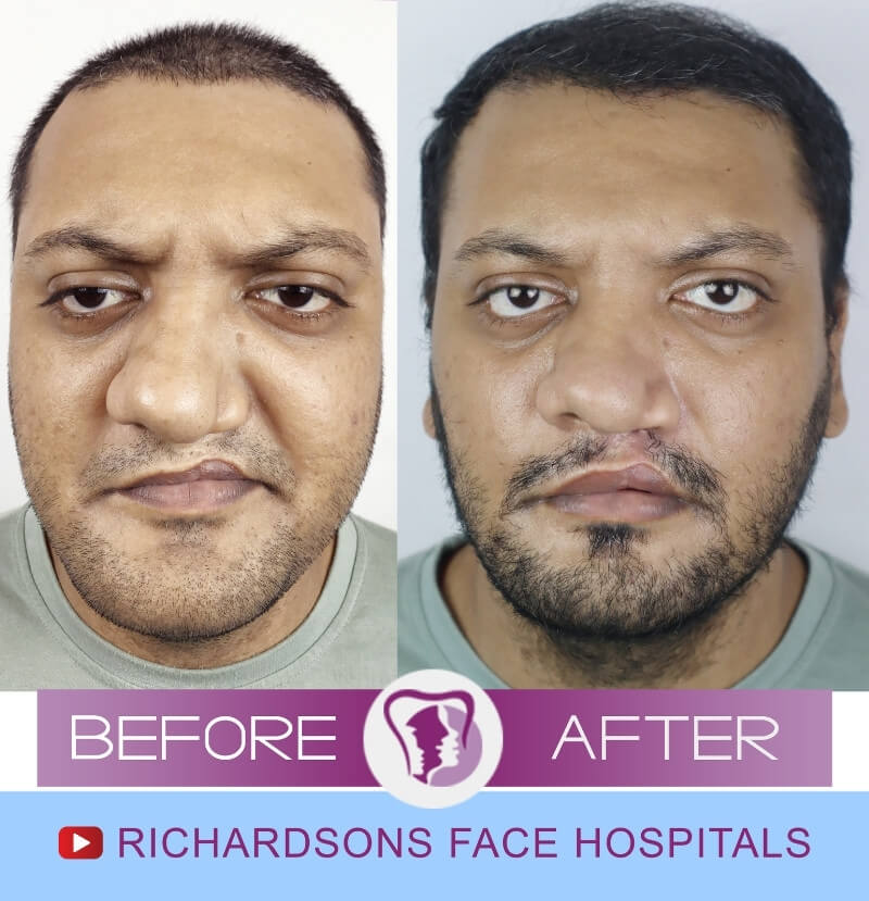 Bharathwaj Nose Surgery