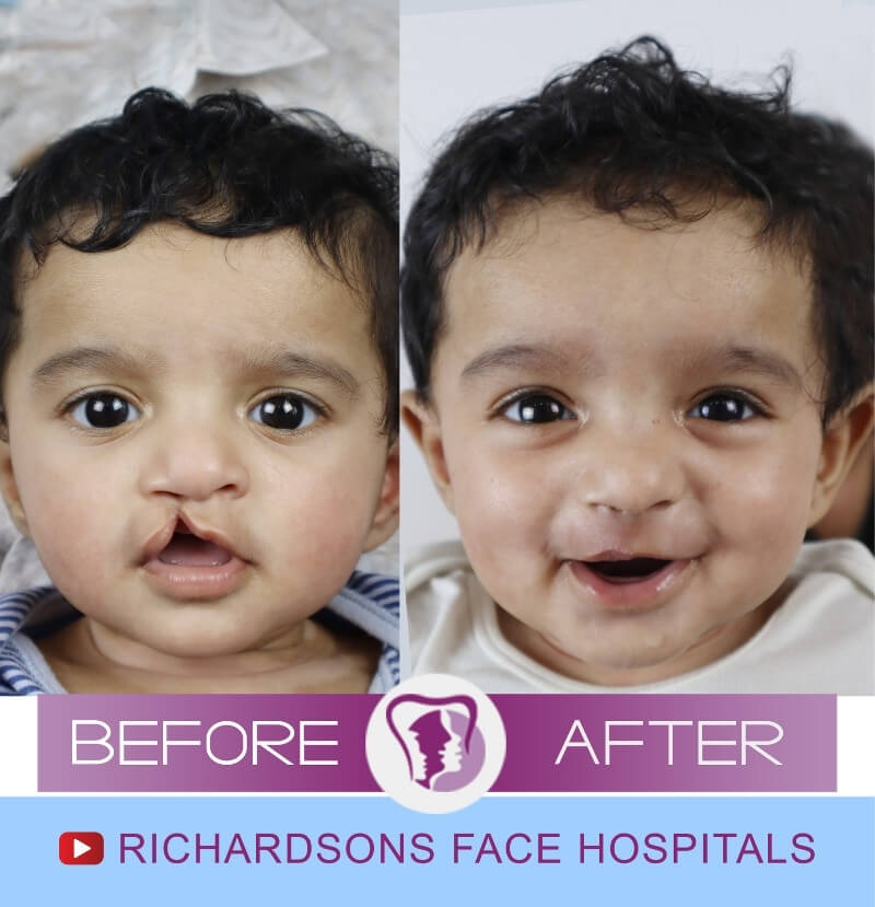 Emad Cleft Lip Palate Surgery