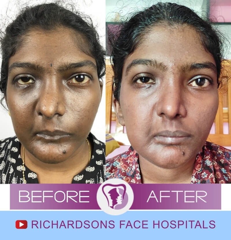 Facial Asymmetry Surgery Mounisha