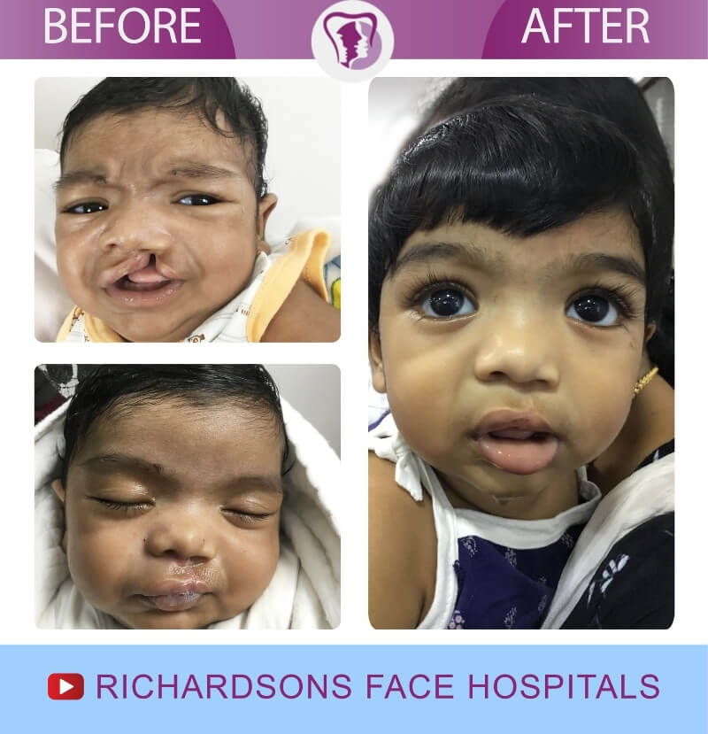 Fidel Cleft Lip Palate Surgery