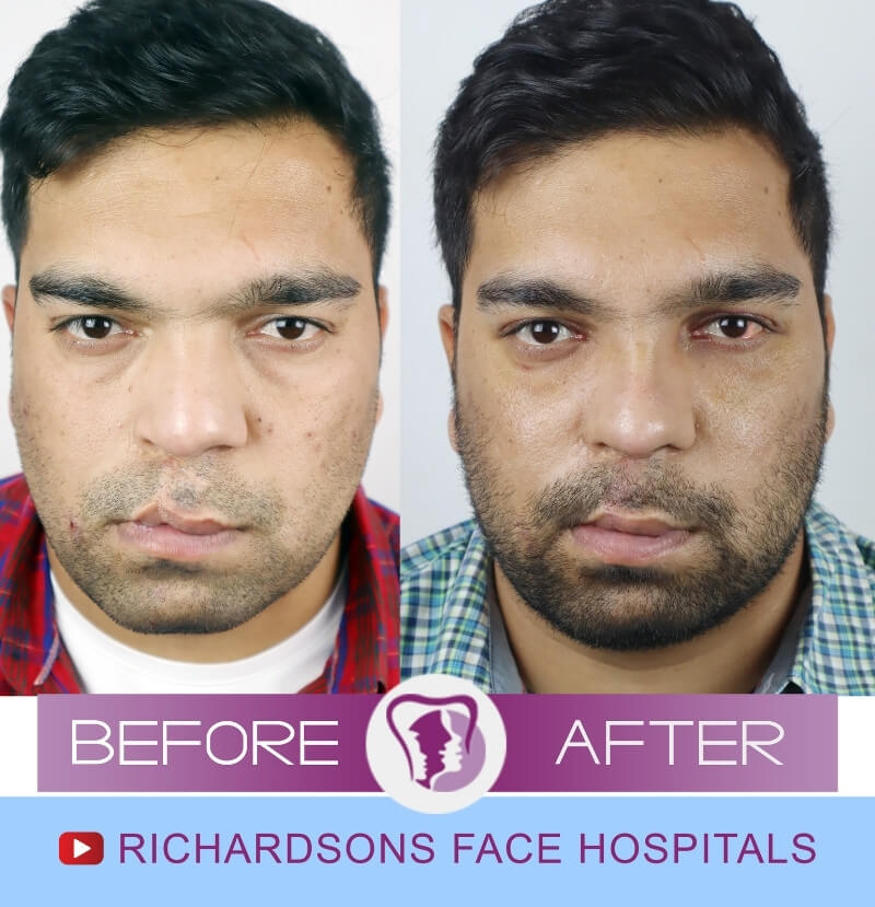 Gagandeep Lip Reduction Surgery