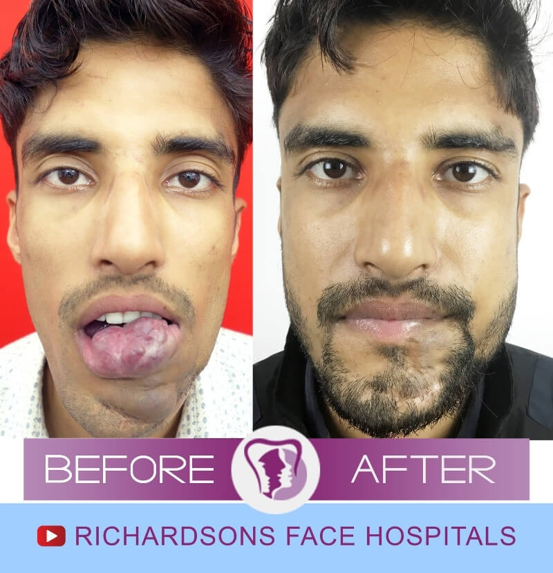 Gaurav Lip Hemangioma Treatment