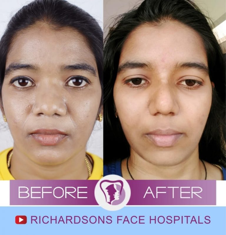 4 Things You Must Know About Tip Refinement Rhinoplasty in India Richardson's Plastic Surgery