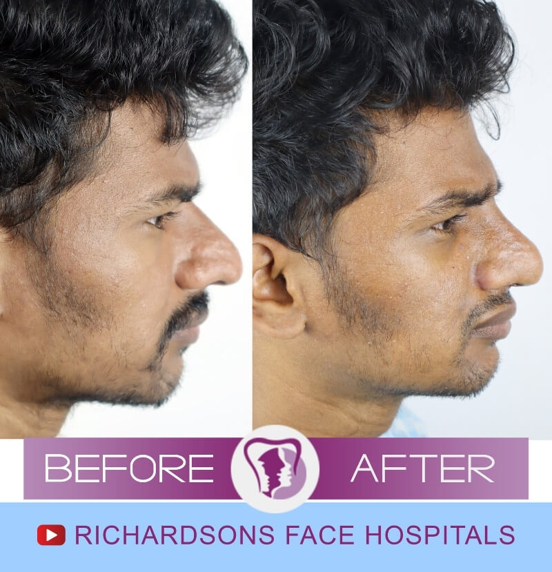 Indluru Nose Surgery India