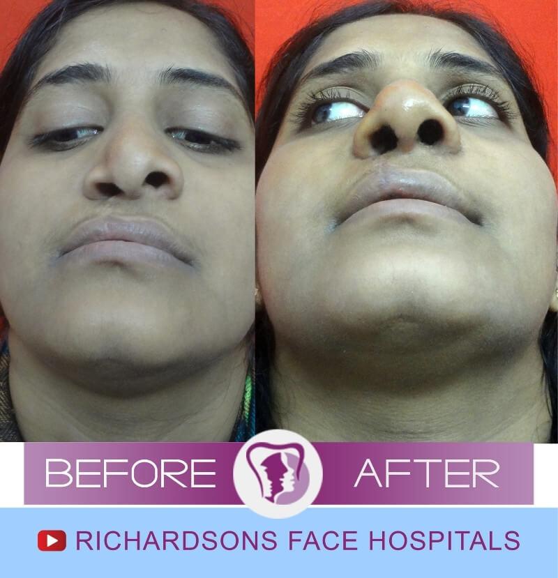 Nikitha Rhinoplasty Surgery
