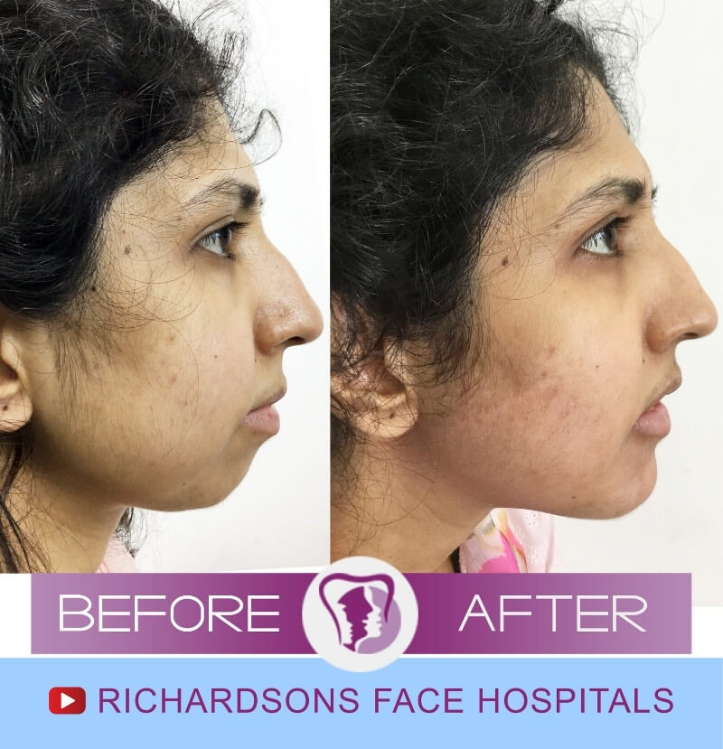 Noor Nose Surgery Side View