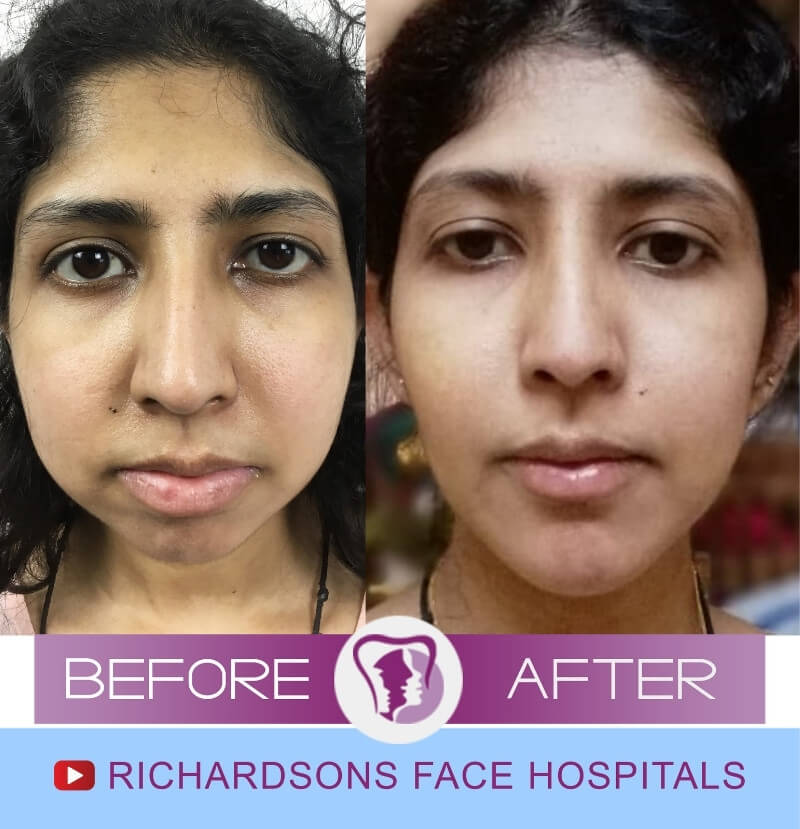 Noor Nose Surgery
