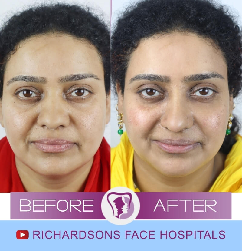 Noorani Nose Surgery India