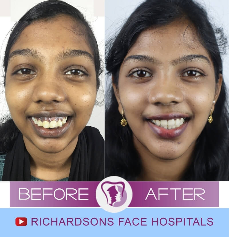 Nose Surgery Ashmi