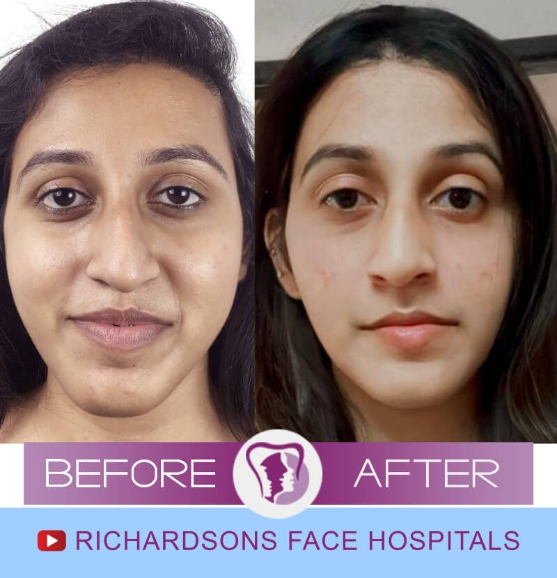 Sanjana Jaw Surgery