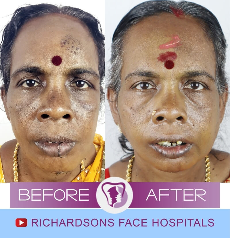Selvi Facial Trauma Surgery