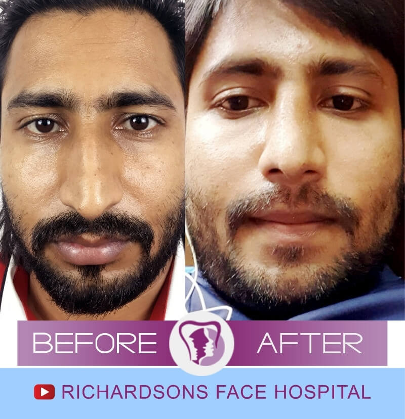 Sharukh Rhinoplasty Surgery