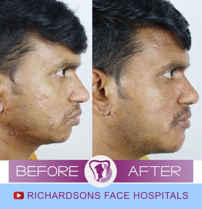 http://Suneel%20Scar%20Removal%20Surgery