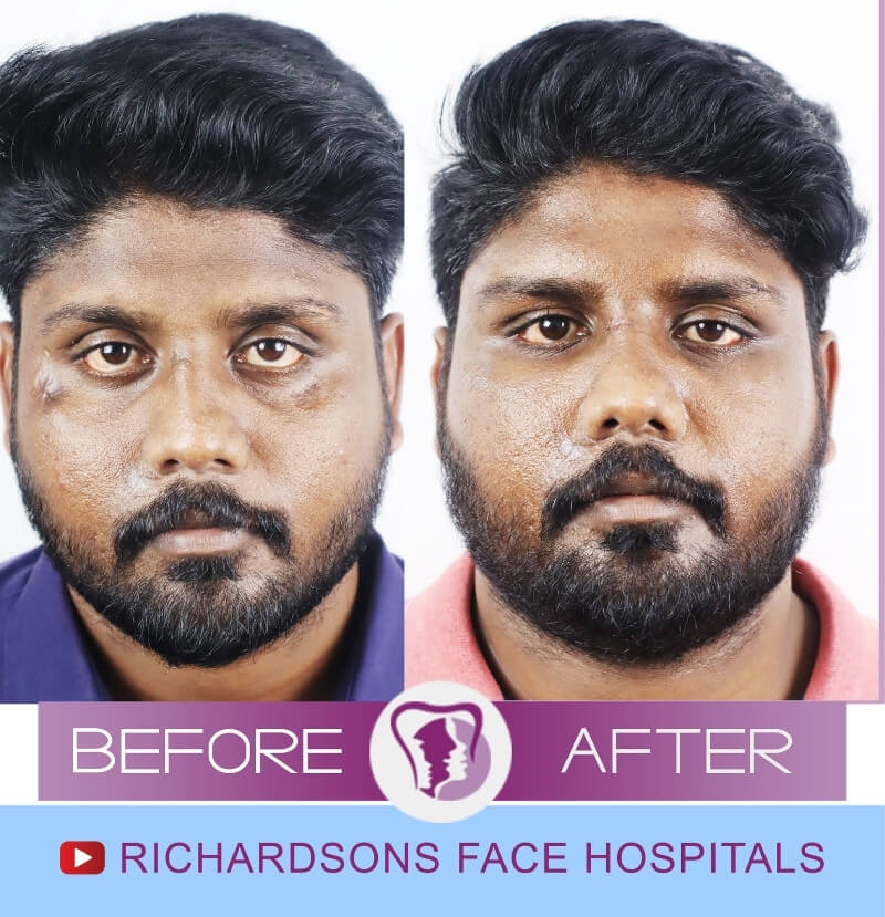 http://Suresh%20Scar%20Removal%20Surgery