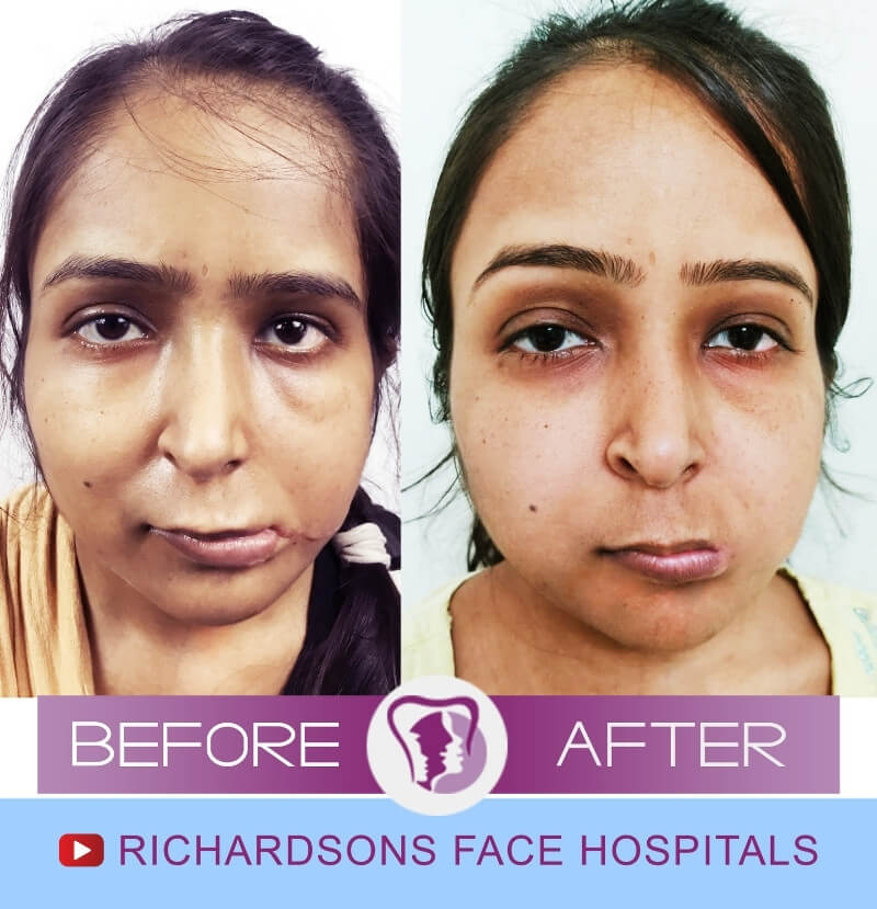Aahuti Raj Facial Asymmetry Surgery