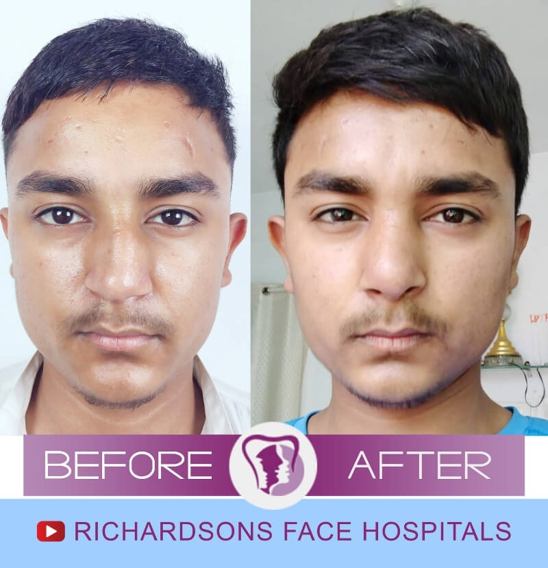 Anuj Rhinoplasty Surgery