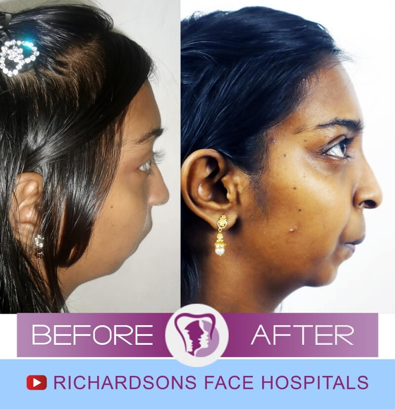 Facial Asymmetry Surgery Jisha