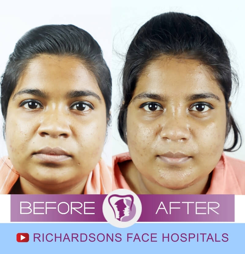 Haleema Facial Asymmetry Surgery