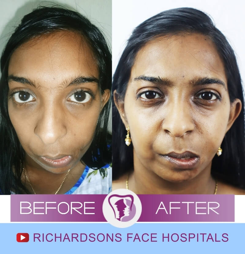 Jisha Facial Asymmetry Surgery