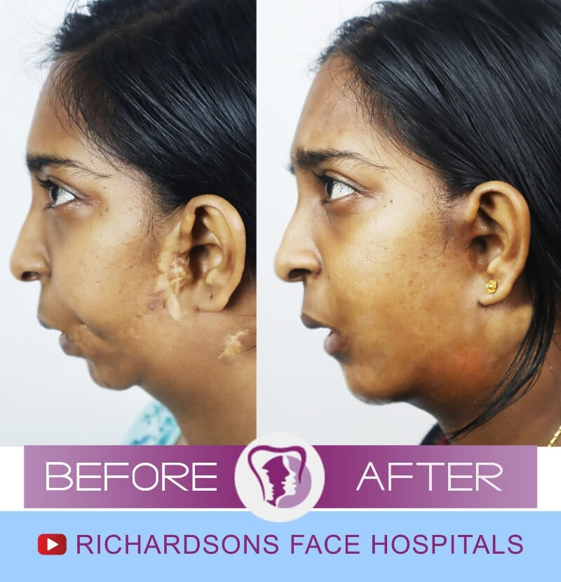 Before After Jisha Facial Asymmetry