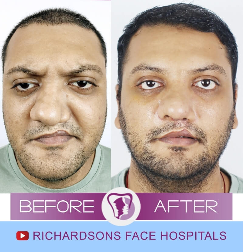 Bharathwaj Rhinoplasty Surgery