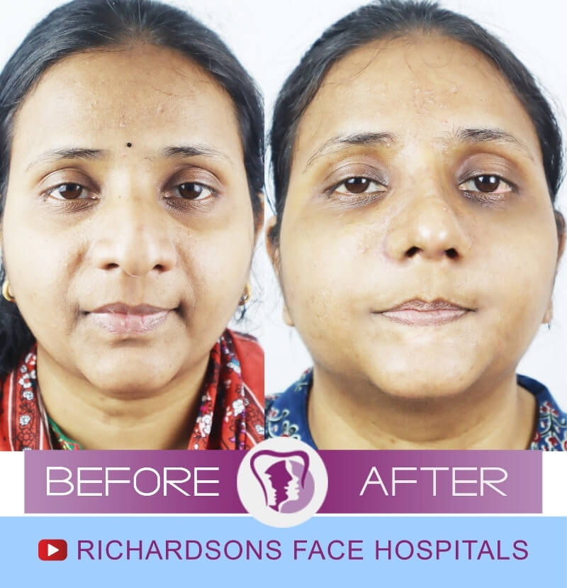 Chandrapu Rhinoplasty Surgery