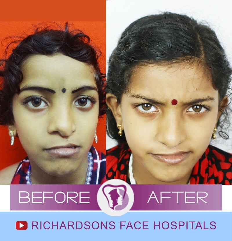 Devanantha Rhinoplasty Surgery