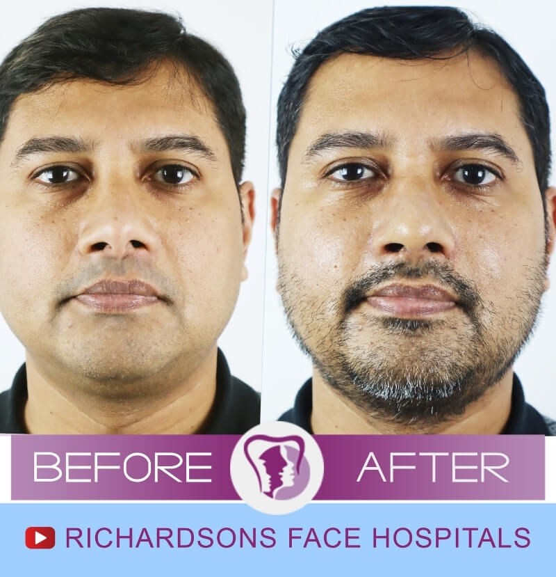 Dhananjay Rhinoplasty Surgery