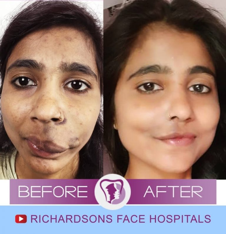 All That You Must Know About Hemangiomas Richardson's Plastic Surgery Hospitals