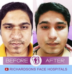 Rahul Rhinoplasty Surgery