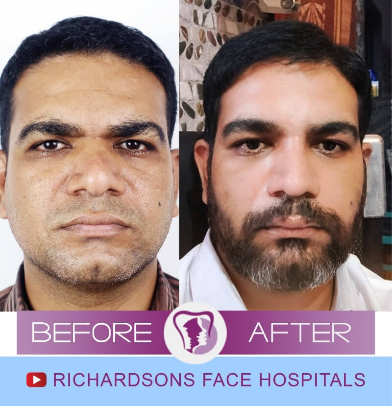 Rajesh Rhinoplasty Surgery