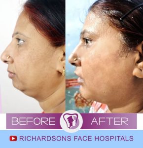 Rekha Facial Asymmetry Correction
