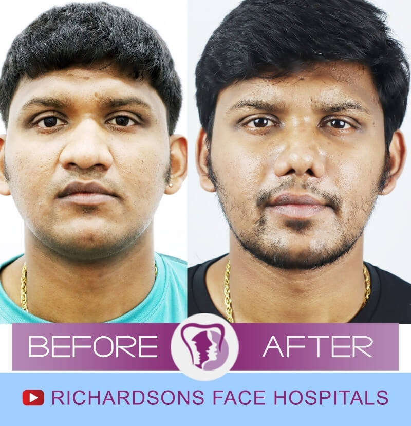 Sibi Kumar Rhinoplasty Surgery