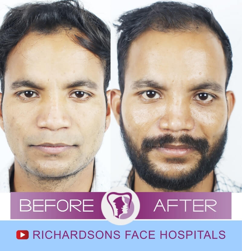Anit Kumar Rhinoplasty Surgery