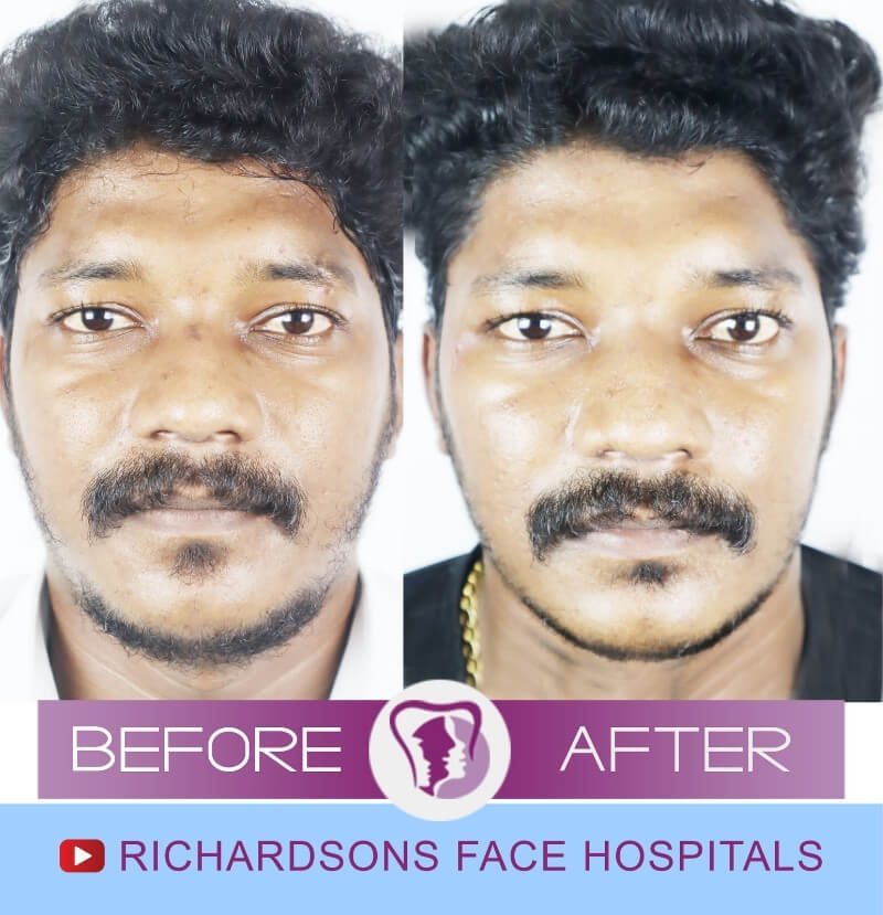 Arun Kumar Scar Surgery