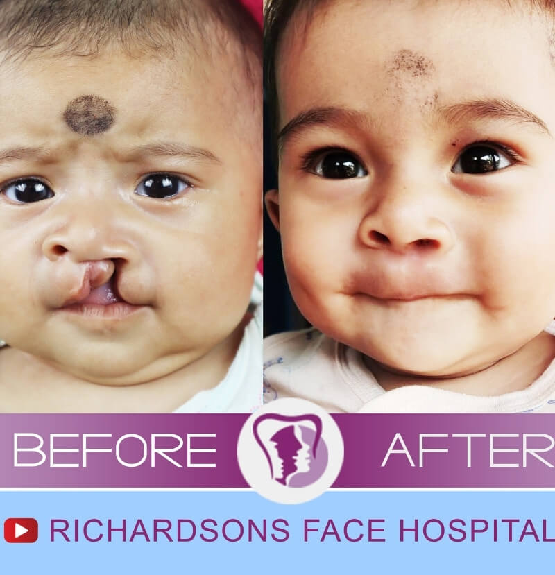 Driya Rabha Rhinoplasty Surgery