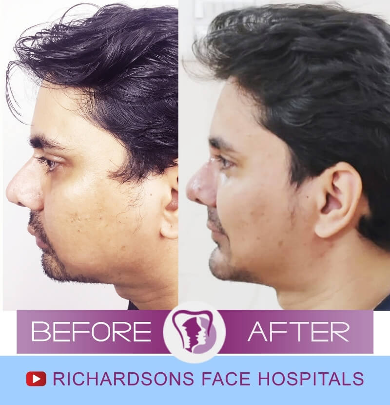 Genioplasty Surgery Rahul