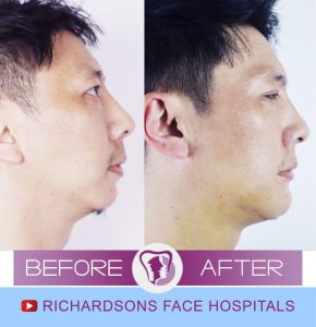 Jaw Surgery Wangchuk