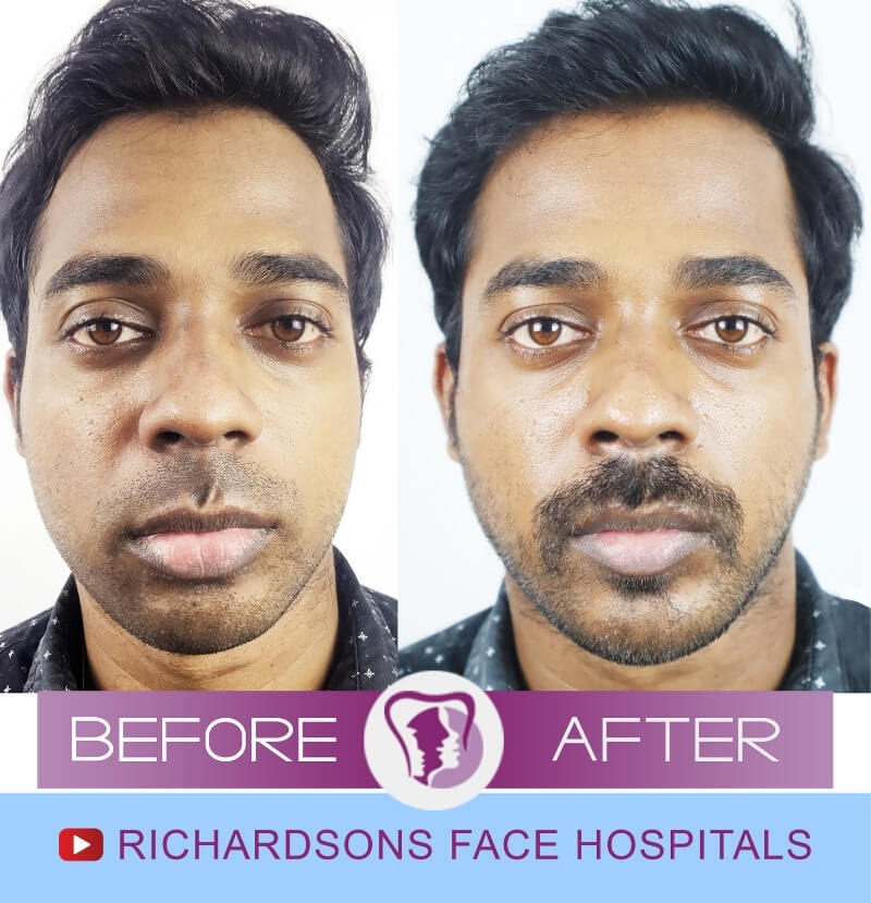 Karthick Scar Surgery