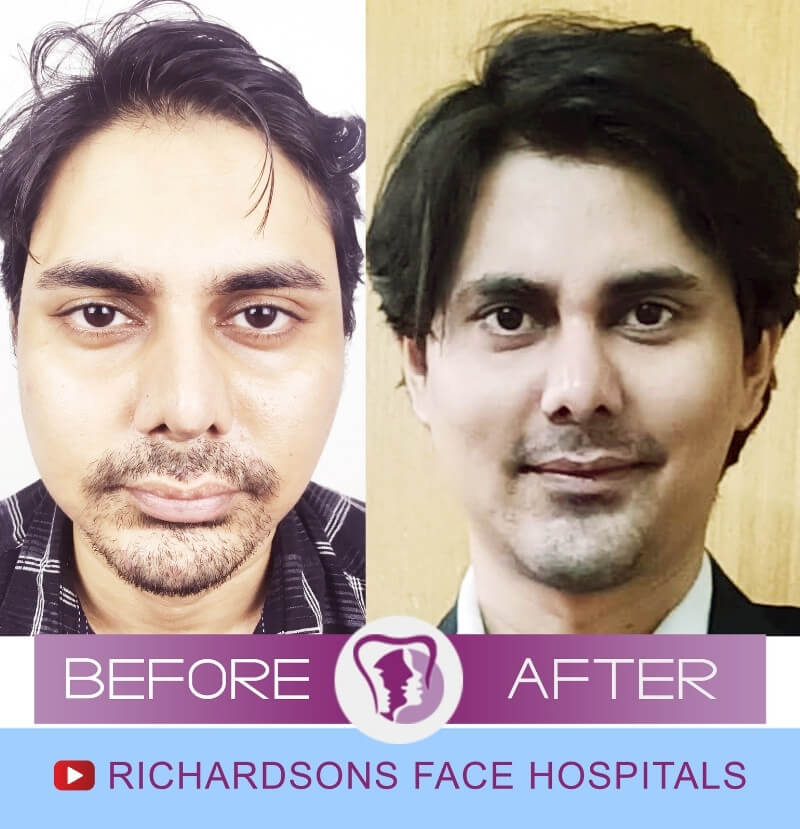Rahul Genioplasty Surgery